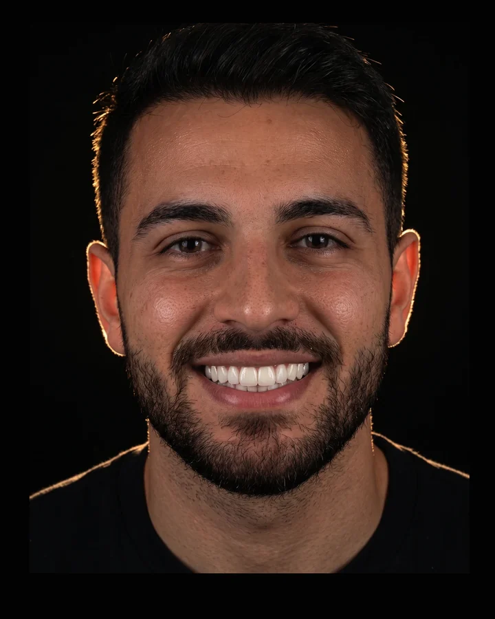 Studio reconstruction of a patient with an open smile, ceramic smile design on a black background